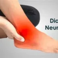 Diabetic Neuropathy
