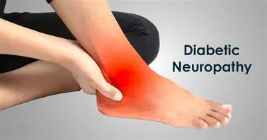 Diabetic Neuropathy